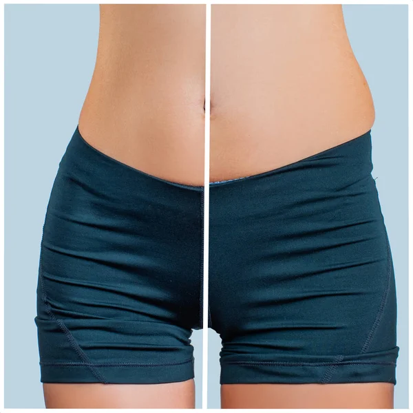 Female Body Liposuction Plastic Surgery Concept Weight Loss — Stock Photo, Image
