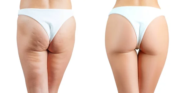 Glutei Femminili Prima Dopo Trattamento Massaggio Anticellulite Concetto Chirurgia Plastica — Foto Stock