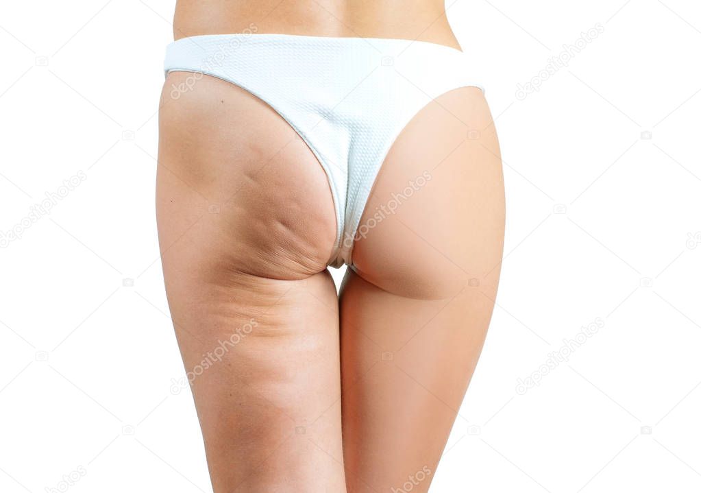 Female buttocks before and after treatment anti cellulite massage. Plastic surgery concept