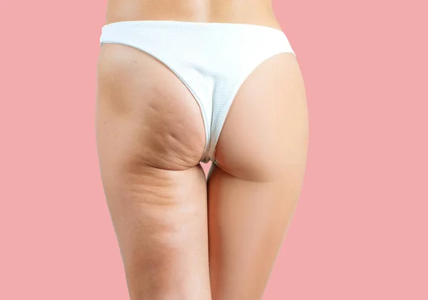 Vrouwelijke Billen Vóór Cellulitis Behandeling Roze Pastel Achtergrond — Stockfoto