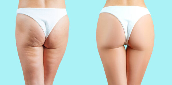 Female buttocks before and after anti cellulite treatment on pastel blue background