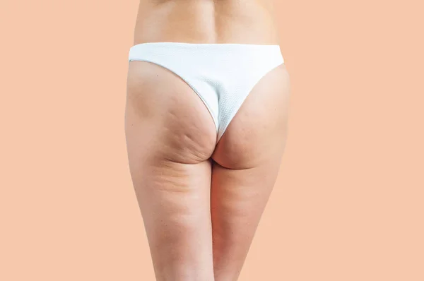 Fesses Féminines Avec Cellulite Cellulite Peau Chez Femme Fesses Sur — Photo