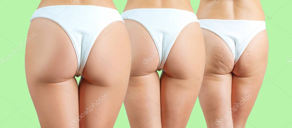 Female buttocks before and after anti cellulite treatment on pastel green background