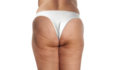 Selülitli kadın kalçaları. Selülit cilt