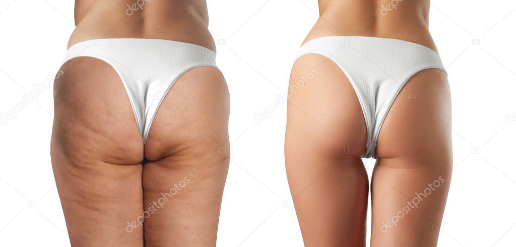 Cellulite treatment. Female buttocks before and after anti cellulite massage. 