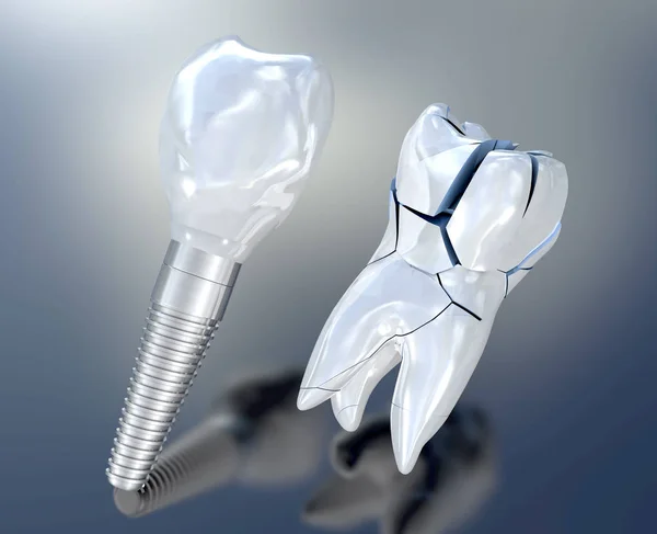 3d illustration of a broken white tooth an a tooth implant