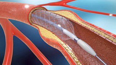 kan dolaşımı kan damarlarının içine desteklemek için stent implantasyonu 3D çizimi