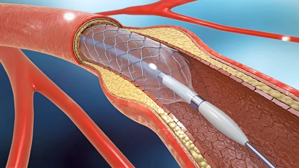 Illustration Der Stent Implantation Zur Unterstützung Der Blutzirkulation Blutgefäße — Stockfoto