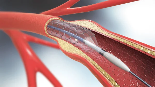 kan dolaşımı kan damarlarının içine desteklemek için stent implantasyonu 3D çizimi