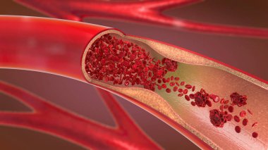 3d illustration of a constricted and narrowed artery and the blood cannot flow properly called arteriosclerosis clipart