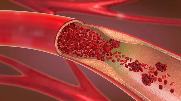 Obrázek Zúžené Zúžení Tepny Krev Nemůže Proudit Správně Nazývané Arterioskleróza — Stock fotografie