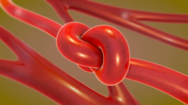3d illustration of a knot in an artery being constricted and narrowed called arteriosclerosis clipart