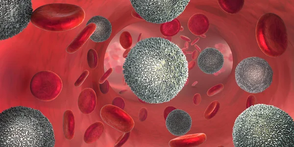 说明称为白血病细胞的非功能白细胞大量增加 导致血癌疾病 — 图库照片