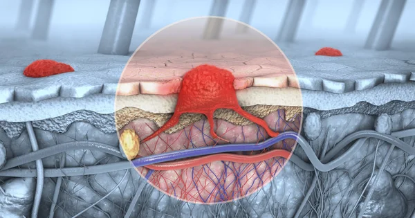 Illustration Ett Tvärsnitt Sjuka Hud Med Melanom Som Kommer Blodomloppet — Stockfoto