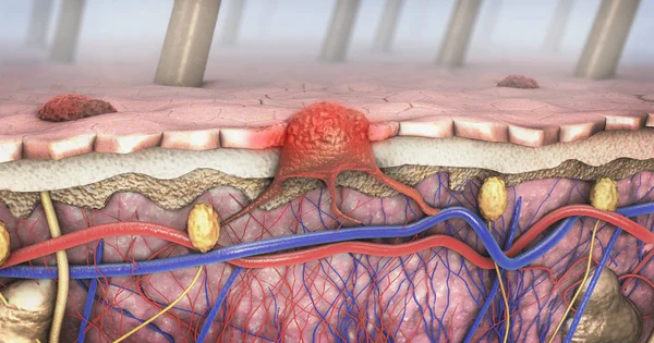 Ilustración Una Sección Transversal Una Piel Enferma Con Melanoma Que — Foto de Stock