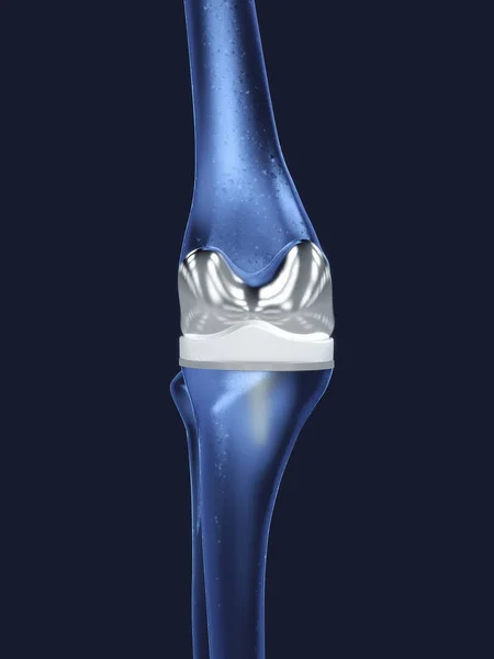 Prótesis de rodilla artificial o articulación de rodilla en tonos azules - Ilustración 3D —  Fotos de Stock