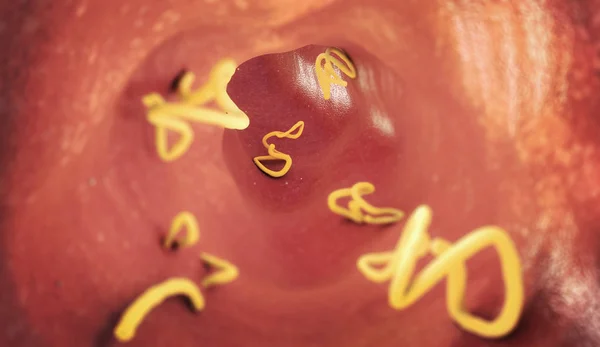 Infestación por tenia en un intestino humano - ilustración 3d — Foto de Stock