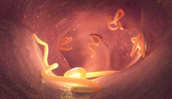 Tapeworm infestation in a human intestine - 3d illustration — Stock Photo, Image