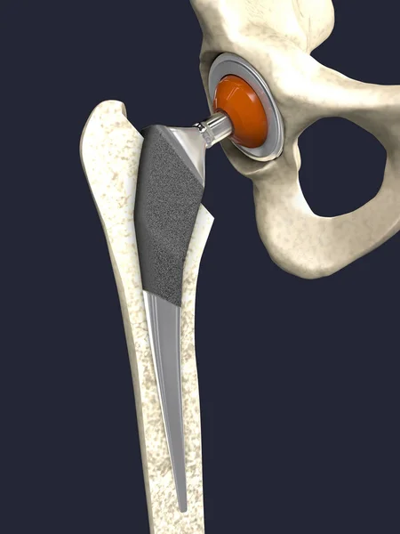 Function of a hip joint implant or hip prosthesis in frontal view - 3d illustration — Stock Photo, Image