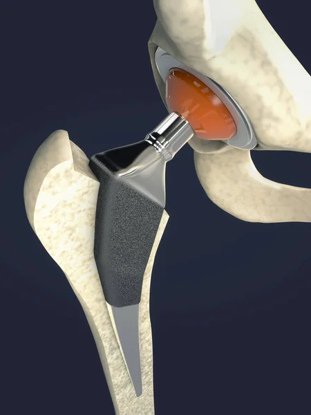 Funktion eines Hüftgelenkimplantats oder einer Hüftprothese in Frontalansicht - 3D-Illustration — Stockfoto