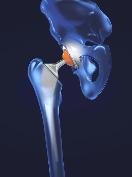 Función de un implante de articulación de cadera o prótesis de cadera en vista frontal - ilustración 3D —  Fotos de Stock