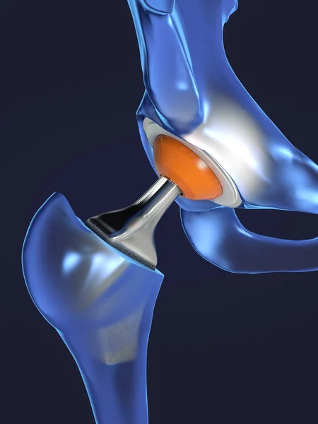 Function of a hip joint implant or hip prosthesis in frontal view - 3d illustration — Stock Photo, Image