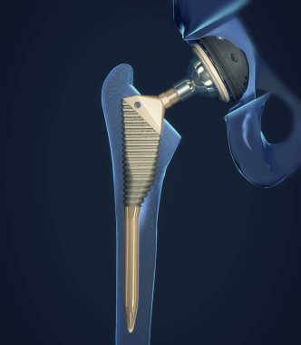 Function of a hip joint implant or hip prosthesis in frontal view - 3d illustration clipart