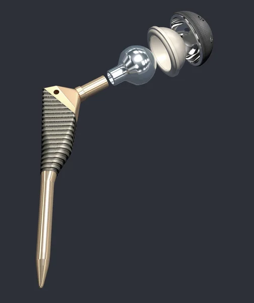 Función de un implante de articulación de cadera o prótesis de cadera en vista frontal - ilustración 3D — Foto de Stock