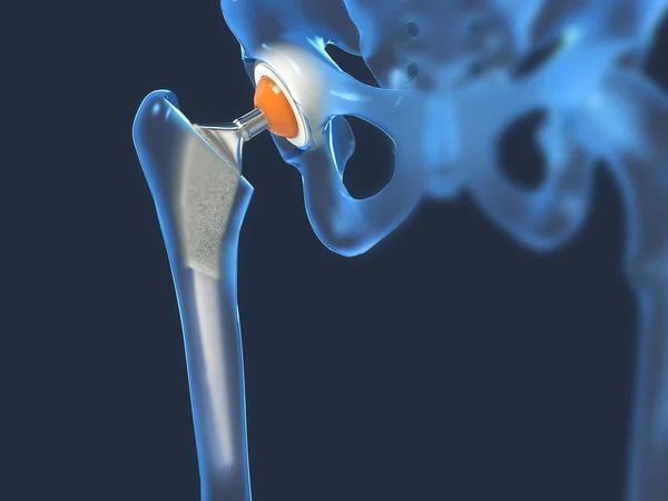 Función de un implante de articulación de cadera o prótesis de cadera en vista frontal - ilustración 3D —  Fotos de Stock
