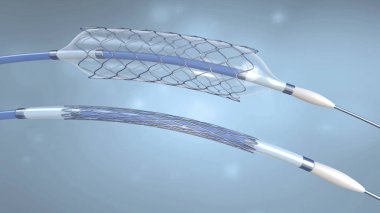 Boş ve dolu bir balon ile kan damarlarına implantasyon için stent ve kateter-3D illüstrasyon
