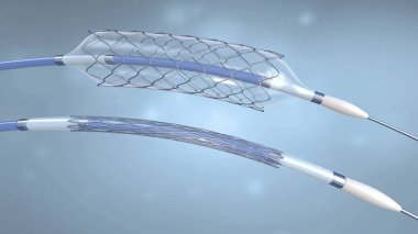 Stent and catheter for implantation into blood vessels with an empty and filled balloon - 3d illustration clipart