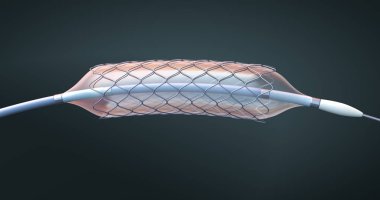 İmplantasyon ve kan damarlarına kan dolaşımı destekleme için stent ve kateter-3D illüstrasyon