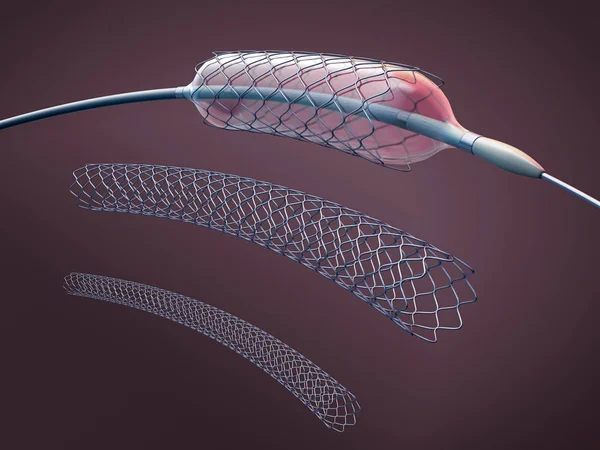 Trzy metalowe stenty do implantacji i wspomagające krążenie krwi w naczyniach krwionośnych i cewnikach-ilustracja 3D — Zdjęcie stockowe