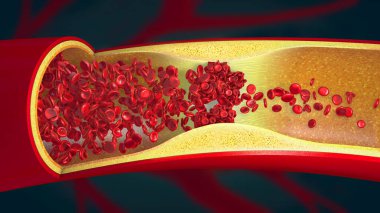 Embolism caused by a blood clot in a constricted blood vessel - 3d illustration clipart
