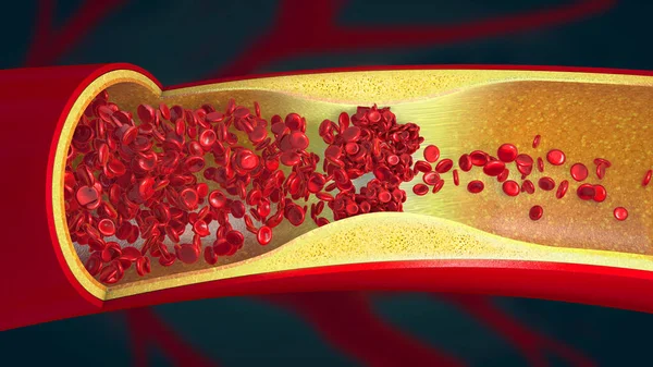 狭窄血管中的血凝块引起的栓塞 3D例 — 图库照片