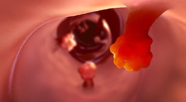 Close-up view of intestinal polyps and diseased intestinal tissue that can cause cancer - 3d illustration