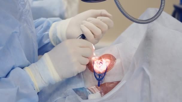 Крупним планом знімок рук хірургів, він виконує операцію з відновлення зору — стокове відео