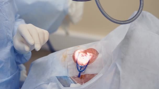 Ophtalmologiste change lentille oculaire de l'homme pendant l'opération — Video