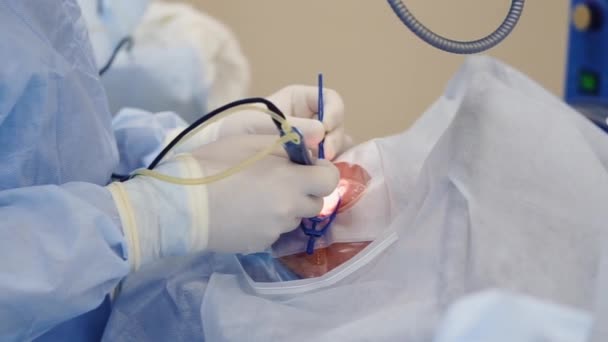 Close-up tiro de um médico mãos, um oftalmologista está tratando um globo ocular — Vídeo de Stock