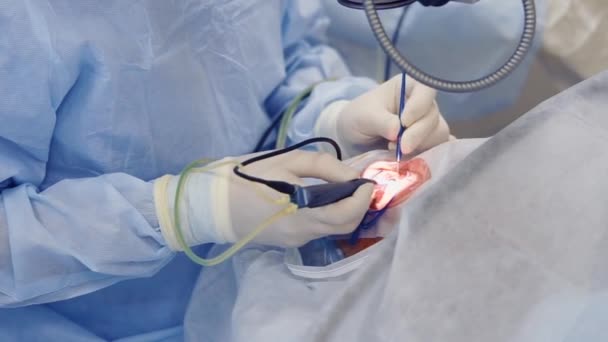 Квалифицированный хирург на операции — стоковое видео