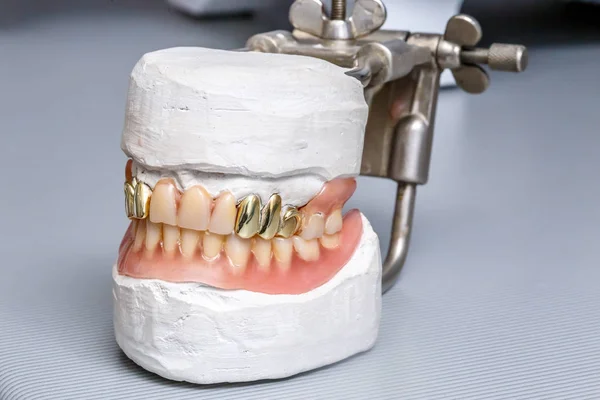 Dental gold teeth prosthesis, clay mold human gums model in jaws prothetic laboratory, close-up