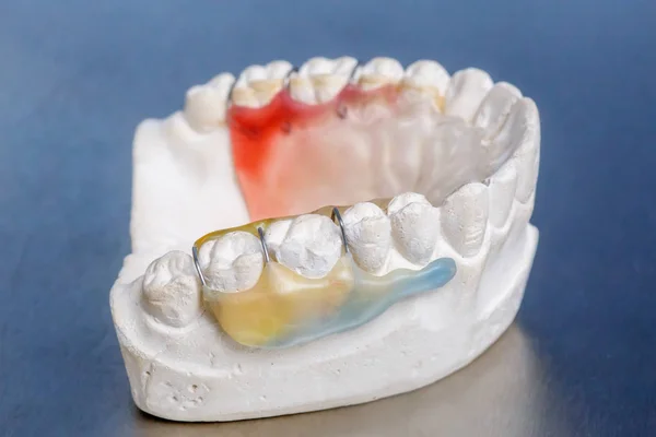 Coloridos Frenos Dentales Retenedor Molde Dientes Modelo Encías Humanas Arcilla — Foto de Stock