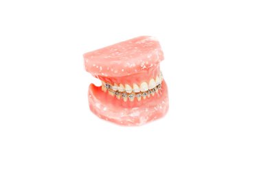 Çene veya Dişleri ortodontik model izole, metal tel diş diş telleri