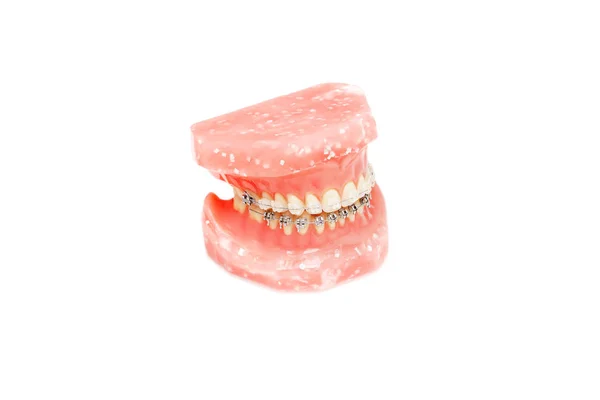 Metall Wire Dental Braces Jaw Teeth Orthodontic Model Isolated — Stock Photo, Image