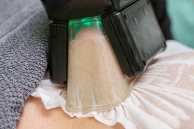 Kadın Cryolipolysis şişman tedavi prosedürü profesyonel kozmetik kabine veya spa Center'da alıyorum.