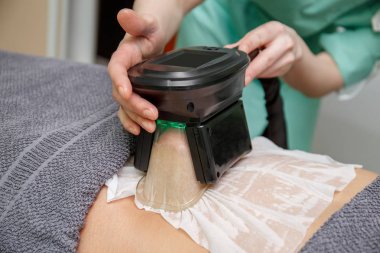 Güzellik terapisti Cryolipolysis tedavi uygulanıyor. Sigara Cerrahi yağ azaltma ve vücut kozmetik dolapta heykel