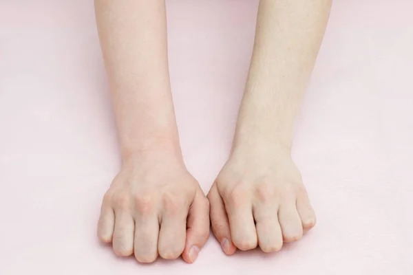 Confronto prima e dopo la depilazione degli zuccheri sulle braccia — Foto Stock