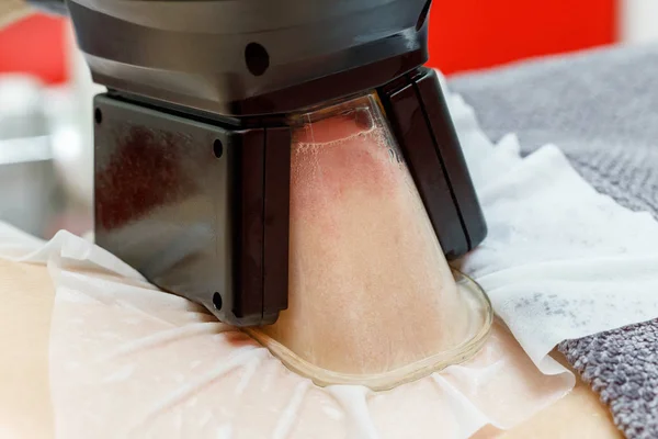 Criolipólisis congelar procedimiento de grasa en el salón de cosméticos, primer plano del vientre — Foto de Stock