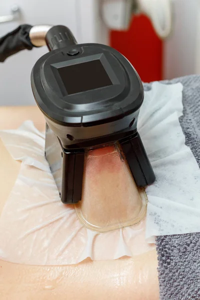Criolipólisis congelar procedimiento de grasa en el salón de cosméticos, primer plano del vientre — Foto de Stock