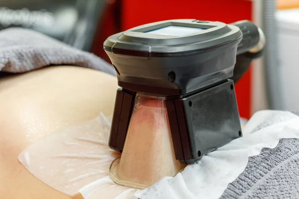 Cryolipolysis freeze fat procedure in cosmetic salon, belly close-up — Stock Photo, Image